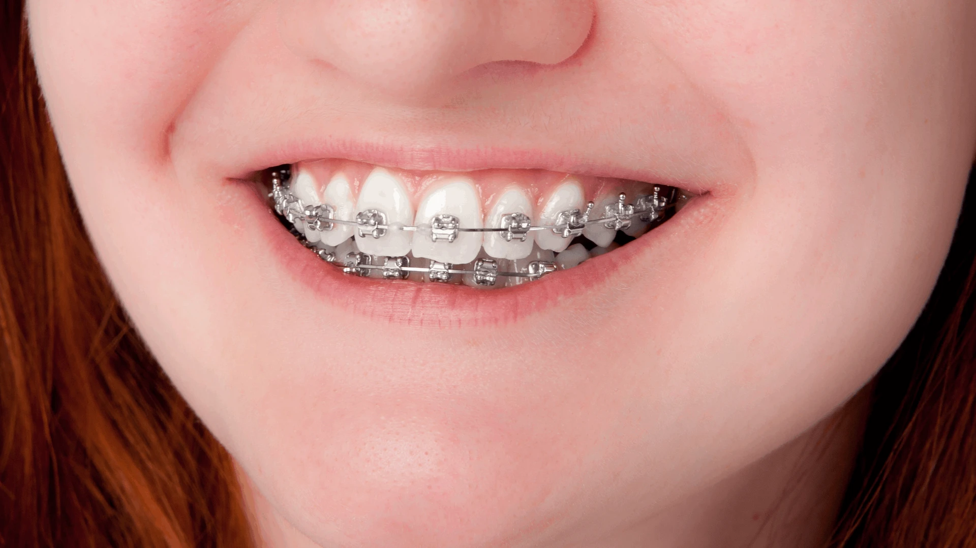 Tænder med bøjle på