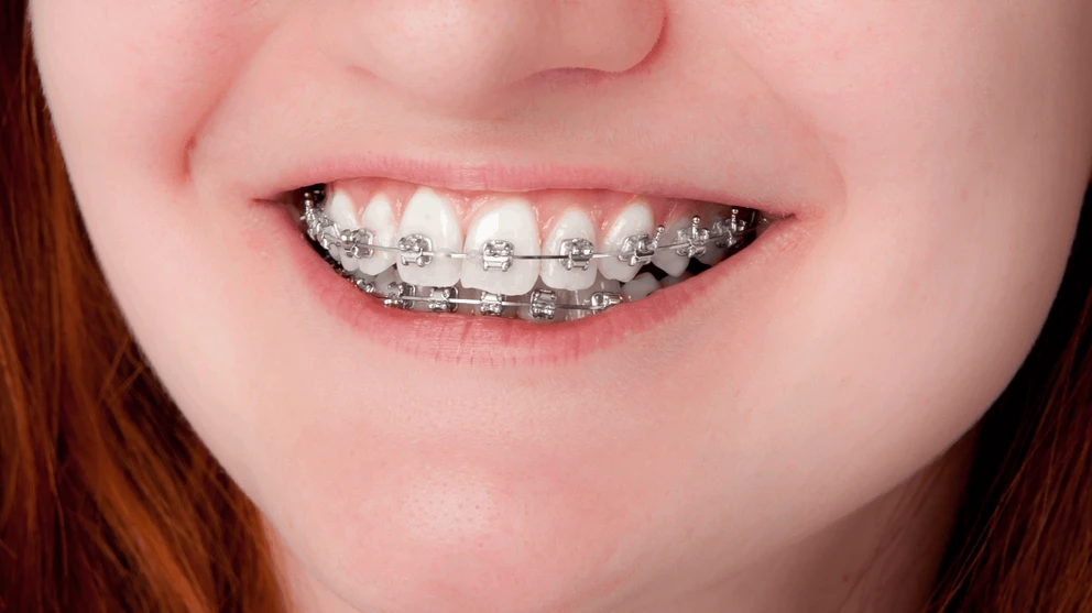 Tænder med bøjle på